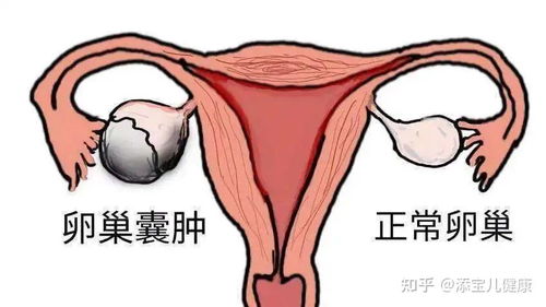 湖北旅游景点直播，卵巢囊肿术后白细胞高的关注与解析