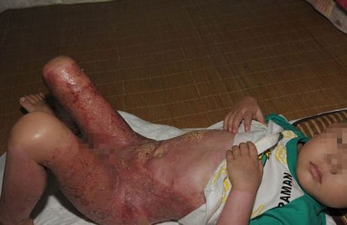 湖北旅游小孩被烫伤,湖北旅游小孩被烫伤视频