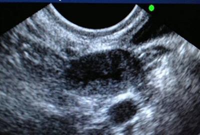 湖北旅游直播间,排了三个卵泡还是没怀孕