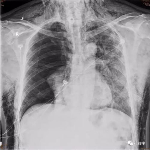 湖北景区接待旅游,侧躺呼吸肺部有声音